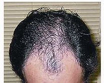 Hair restoration before