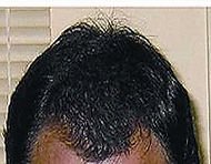 Hair restoration after