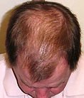 After 6 months hair restoration