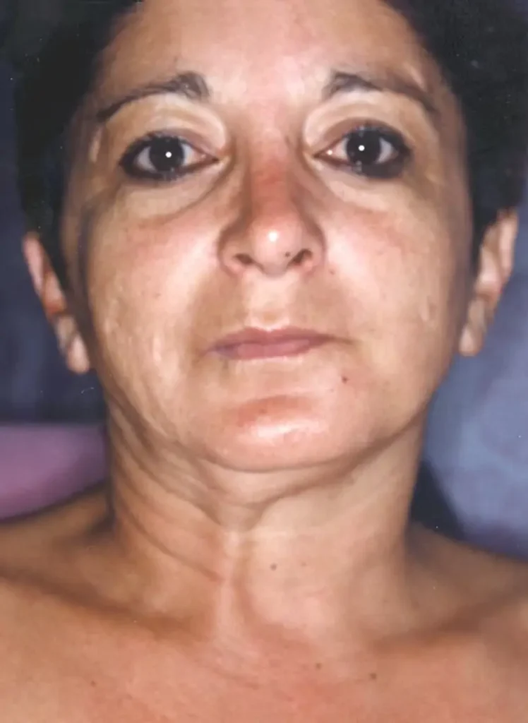 Face - Front - Half Done - Before